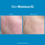 Skin Moisture IQ